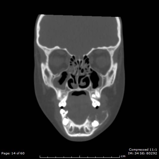 Central giant cell granuloma (Radiopaedia 45612-49754 Coronal bone window 14).jpg