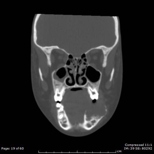 Central giant cell granuloma (Radiopaedia 45612-49754 Coronal bone window 19).jpg