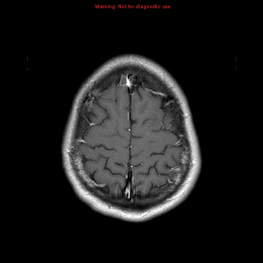 File:Central nervous system vasculitis (Radiopaedia 8410-9235 Axial T1 C+ 21).jpg