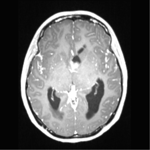 File:Central neurocytoma (Radiopaedia 37664-39557 Axial T1 C+ 38).png