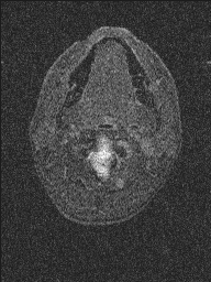 Central neurocytoma (Radiopaedia 56690-63469 Axial T1 C+ 167).jpg