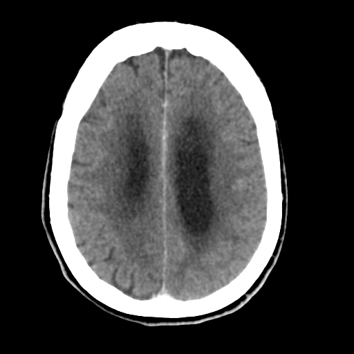 Central neurocytoma (Radiopaedia 65317-74346 Axial C+ delayed 35).png