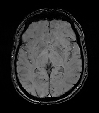 File:Central neurocytoma (Radiopaedia 71068-81303 Axial SWI 31).jpg