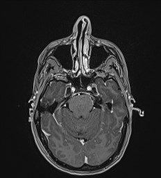Central neurocytoma (Radiopaedia 84497-99872 Axial T1 C+ 47).jpg