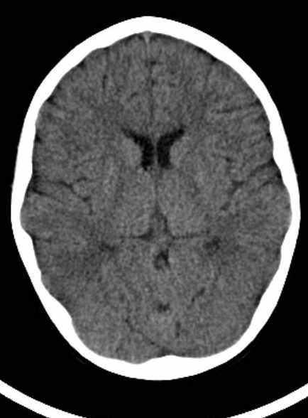 Cerebellar abscess (Radiopaedia 73727-84527 Axial non-contrast 40).jpg