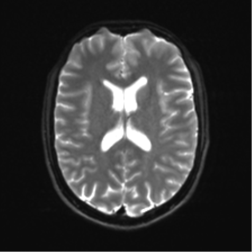 Cerebellar agenesis with hypoplastic pons (pontocerebellar hypoplasia) (Radiopaedia 57224-64138 Axial DWI 23).png