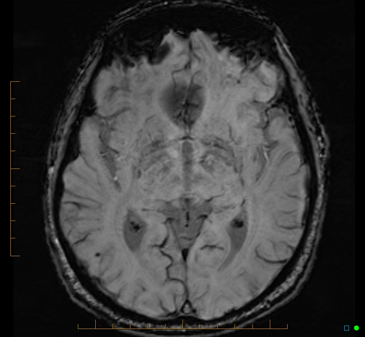 Cerebellar gangliocytoma (Radiopaedia 65377-74422 Axial SWI 27).jpg