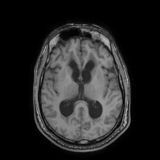 File:Cerebellar hemangioblastoma (Radiopaedia 88055-104622 Axial T1 20).jpg