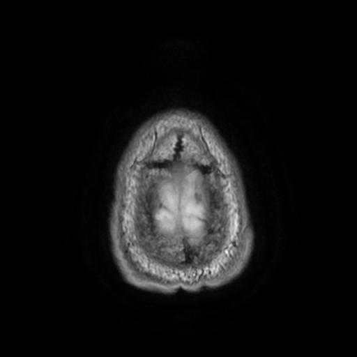 File:Cerebellar hemangioblastoma (Radiopaedia 88055-104622 Axial T1 33).jpg