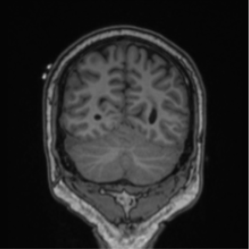 File:Cerebellar hemangioblastomas and pituitary adenoma (Radiopaedia 85490-101176 Coronal T1 27).png