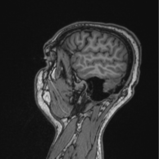 Cerebellar hemangioblastomas and pituitary adenoma (Radiopaedia 85490-101176 Sagittal T1 29).png