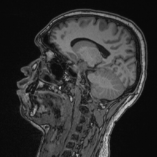 File:Cerebellar hemangioblastomas and pituitary adenoma (Radiopaedia 85490-101176 Sagittal T1 46).png