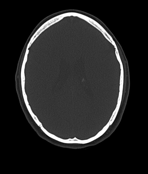 Cerebellar metastases - colorectal adenocarcinoma (Radiopaedia 40947-43652 AX Bone C- 2.0 MPR 39).png