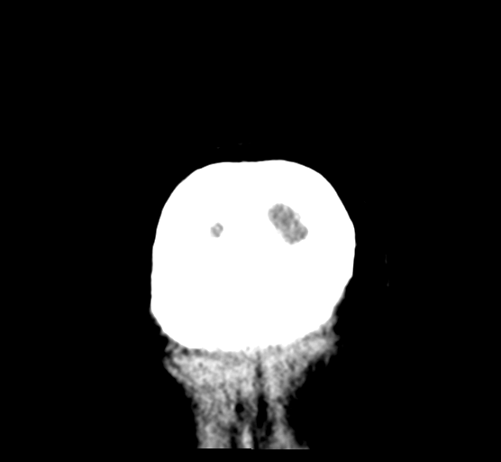 File:Cerebellar metastases - colorectal adenocarcinoma (Radiopaedia 40947-43652 Coronal non-contrast 90).png