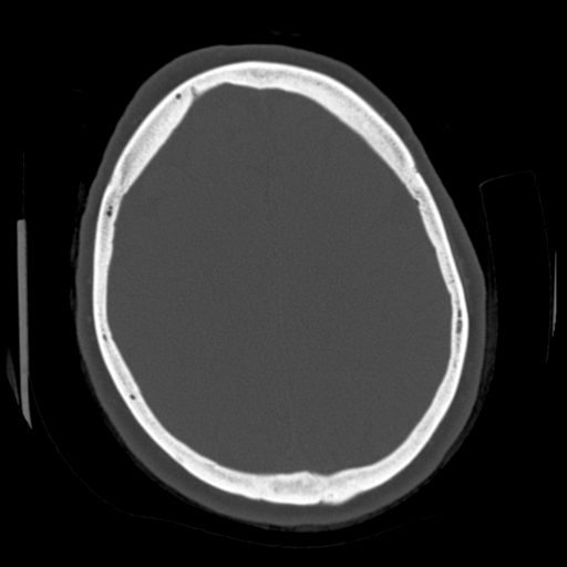 File:Cerebellar metastasis (cystic appearance) (Radiopaedia 41395-44258 Axial bone window 49).png