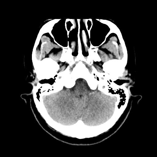 File:Cerebellar metastasis (cystic appearance) (Radiopaedia 41395-44258 Axial non-contrast 12).png