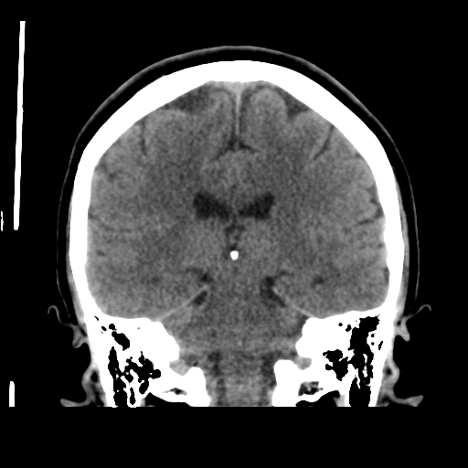 Cerebellar metastasis (cystic appearance) (Radiopaedia 41395-44258 Coronal non-contrast 38).png