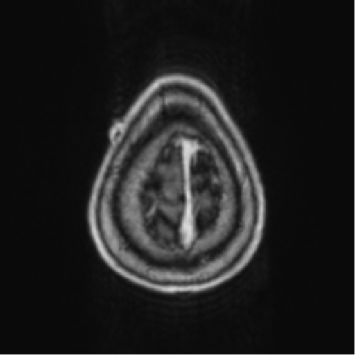 Cerebellar metastasis from lung adenocarcinoma (Radiopaedia 86690-102829 Axial T1 C+ 74).png