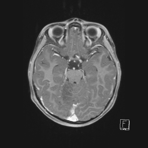 File:Cerebellar stroke (Radiopaedia 32202-33150 Axial T1 C+ 32).png