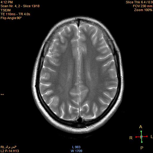File:Cerebellopontine angle meningioma (Radiopaedia 22488-22525 Axial T2 11).jpg