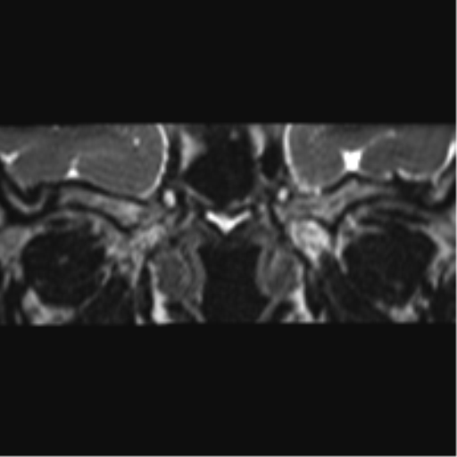 Cerebellopontine angle meningioma (Radiopaedia 48434-53348 Coronal T2 83).png