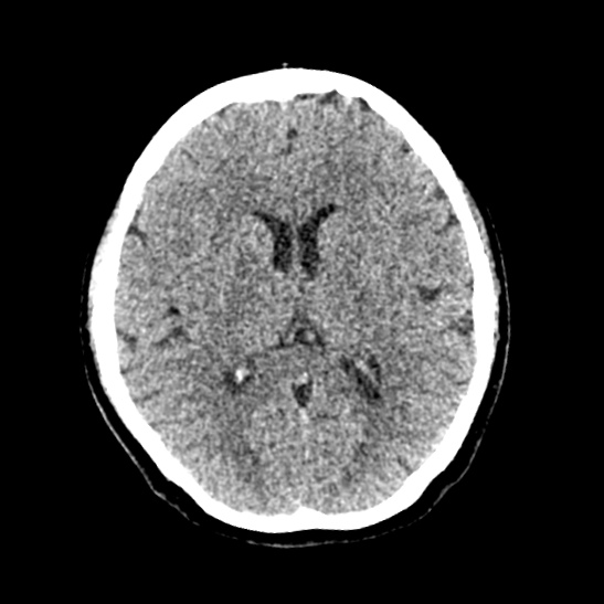 Cerebellopontine angle meningioma (Radiopaedia 53561-59592 Axial non-contrast 37).jpg