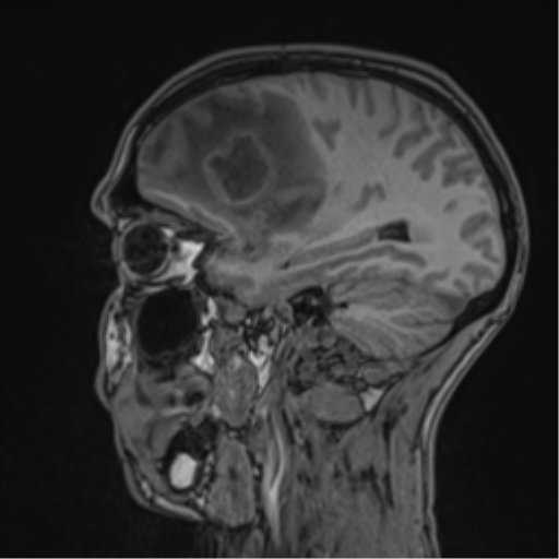 Cerebral abscess (Radiopaedia 60342-68009 Sagittal T1 39).png