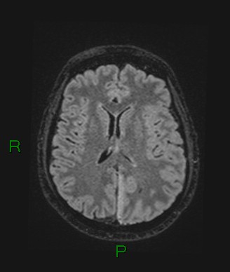 Cerebral abscess and subdural empyema (Radiopaedia 84436-99779 Axial FLAIR 37).jpg