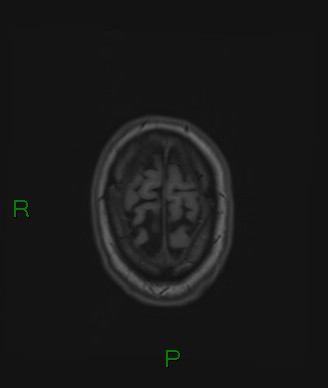 Cerebral abscess and subdural empyema (Radiopaedia 84436-99779 Axial T1 13).jpg