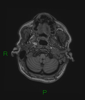 Cerebral abscess and subdural empyema (Radiopaedia 84436-99779 Axial T1 76).jpg