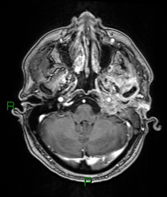 Cerebral abscess and subdural empyema (Radiopaedia 84436-99779 Axial T1 C+ 68).jpg