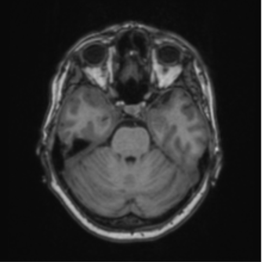 Cerebral abscess from pulmonary arteriovenous malformation (Radiopaedia 86275-102291 Axial T1 26).png