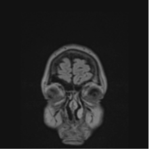 Cerebral abscess from pulmonary arteriovenous malformation (Radiopaedia 86275-102291 Coronal FLAIR 83).png