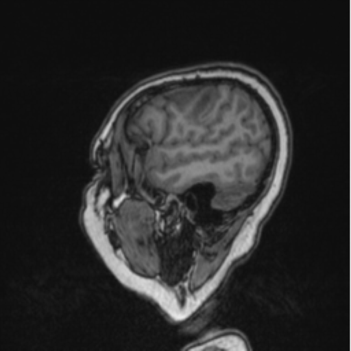 Cerebral abscess from pulmonary arteriovenous malformation (Radiopaedia 86275-102291 Sagittal T1 78).png