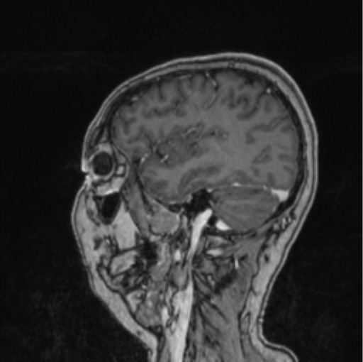 Cerebral abscess from pulmonary arteriovenous malformation (Radiopaedia 86275-102291 Sagittal T1 C+ 21).png