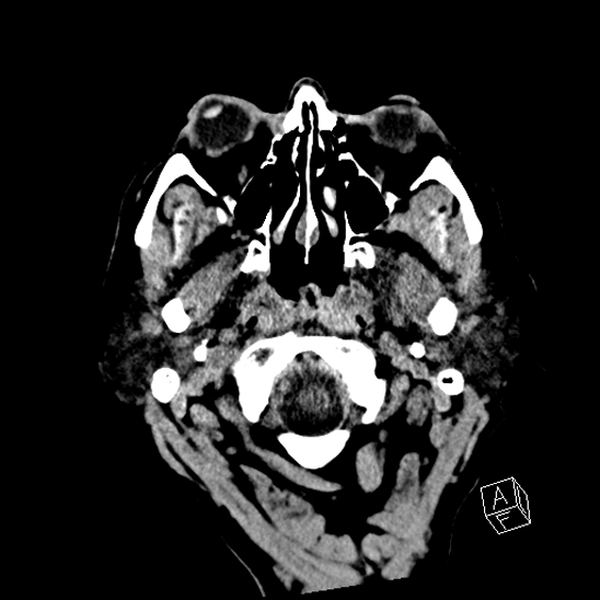 Cerebral abscess with ventriculitis (Radiopaedia 78965-91876 Axial non-contrast 5).jpg