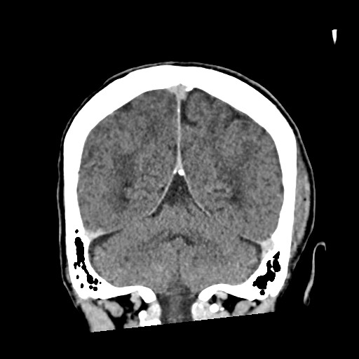 Cerebral amyloid angiopathy-related inflammation (Radiopaedia 74836-85848 Coronal non-contrast 52).jpg