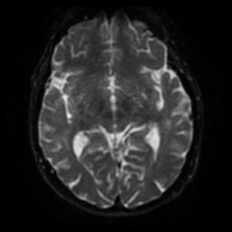 Cerebral amyloid angiopathy (Radiopaedia 28698-28978 Axial DWI 41).jpg