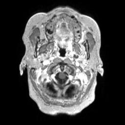 Cerebral amyloid angiopathy (Radiopaedia 29129-29518 Axial T1 C+ 16).jpg