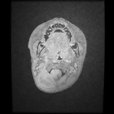 File:Cerebral and spinal tuberculosis (Radiopaedia 90489-107837 Axial T1 C+ 3).jpg