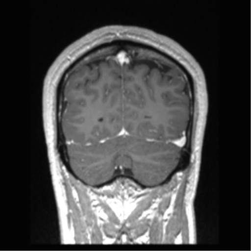 Cerebral arteriovenous malformation (Radiopaedia 39259-41506 Coronal T1 C+ 21).png