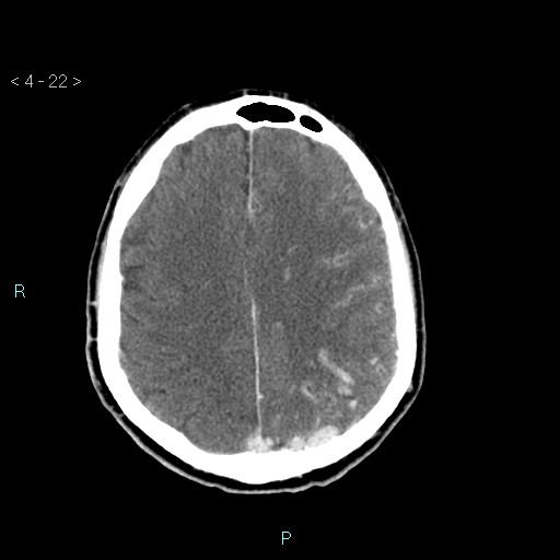 File:Cerebral arteriovenous malformation (Radiopaedia 40528-43125 Axial C+ delayed 22).jpg