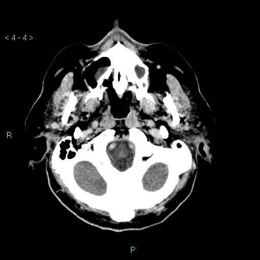 File:Cerebral arteriovenous malformation (Radiopaedia 40528-43125 Axial C+ delayed 4).jpg