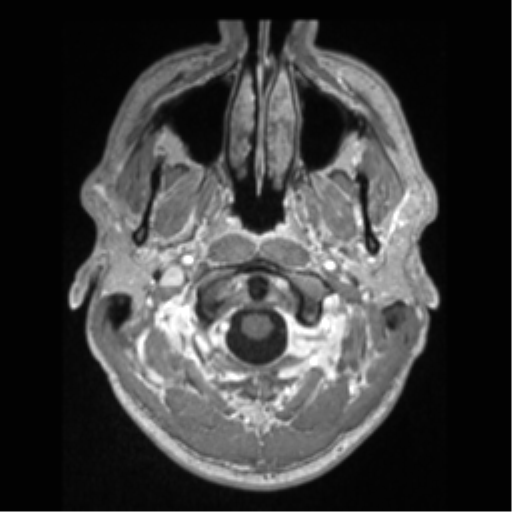 Cerebral arteriovenous malformation (Radiopaedia 55798-62372 Axial T1 C+ 1).png