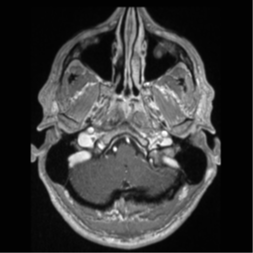 File:Cerebral arteriovenous malformation (Radiopaedia 55798-62372 Axial T1 C+ 9).png