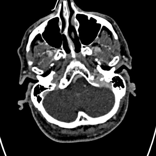 Cerebral arteriovenous malformation (Radiopaedia 78188-90746 Axial C+ delayed 27).jpg
