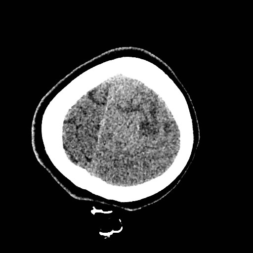 Cerebral arteriovenous malformation (Radiopaedia 79677-92887 Axial non-contrast 57).jpg