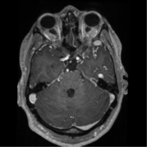 Cerebral arteriovenous malformation - huge (Radiopaedia 35734-37272 Axial T1 C+ 21).png