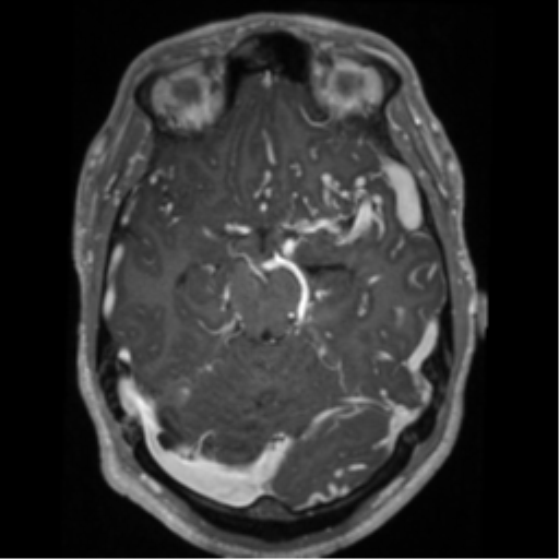 File:Cerebral arteriovenous malformation - huge (Radiopaedia 35734-37272 Axial T1 C+ 26).png