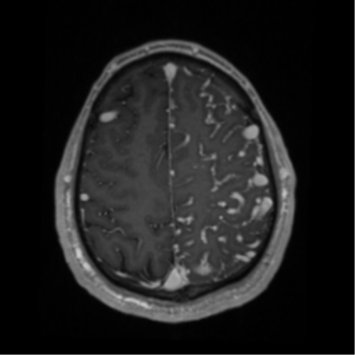 Cerebral arteriovenous malformation - huge (Radiopaedia 35734-37272 Axial T1 C+ 59).png
